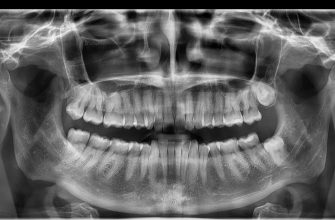 панорамна снимка на зъби Dental X Ray