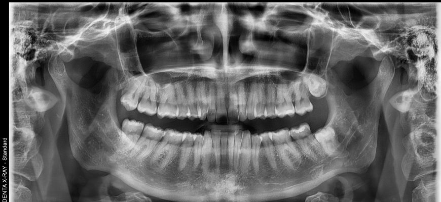 панорамна снимка на зъби Dental X Ray